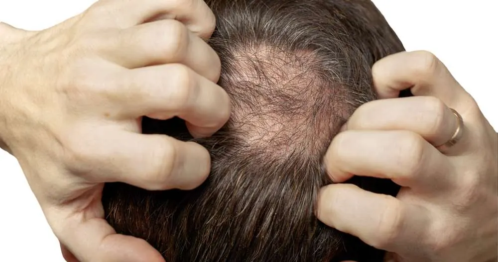 Hombre con alopecia androgénica mirándose al espejo